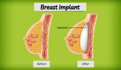 Can You Get Real Results with a Breast Enlargement Pump_