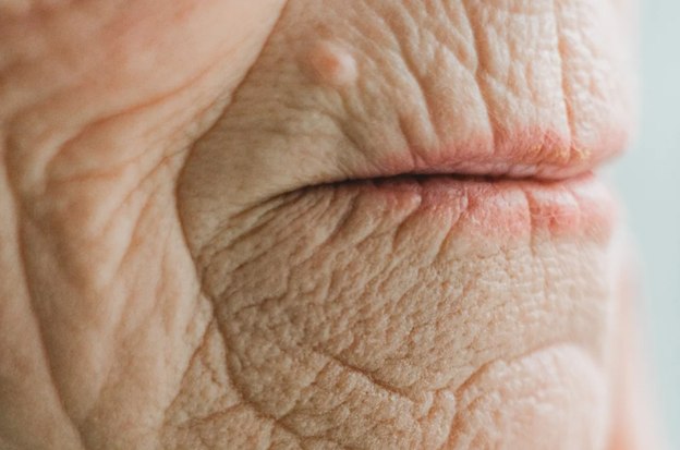 Everything You Need to Know About Microneedling Success