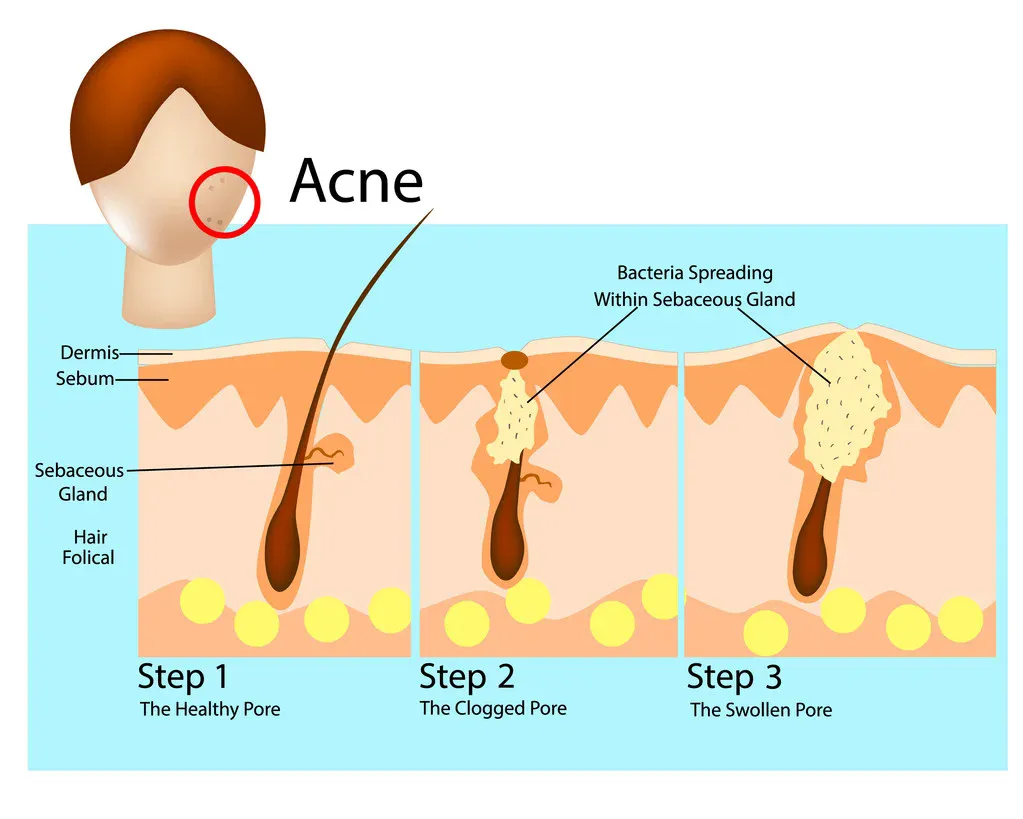 Can High IgE Cause Acne on Your Skin