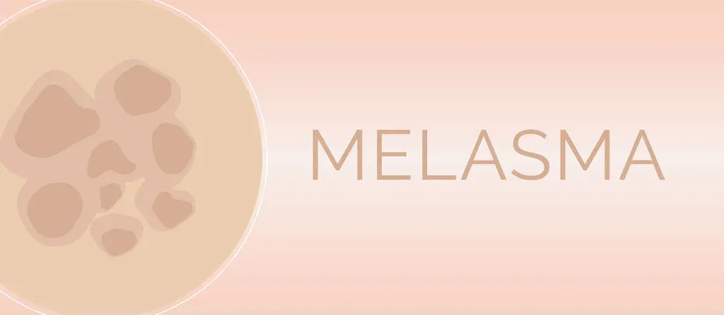 Melasma During Pregnancy